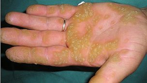 hand infections by metal detecting