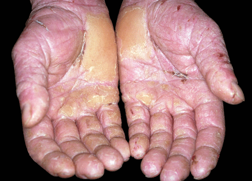 metal detecting skin infections
